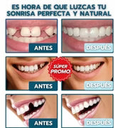 CARILLAS DENTALES 😁✨ SONRISA PERFECTA AL INSTANTE🦷💫