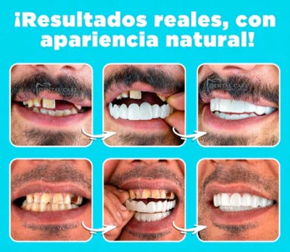 CARILLAS DENTALES 😁✨ SONRISA PERFECTA AL INSTANTE🦷💫