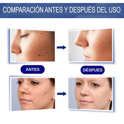 CREMA REMOVEDORA DE VERRUGAS - SUMIFUN 100% ORIGINAL