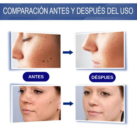 CREMA REMOVEDORA DE VERRUGAS - SUMIFUN 100% ORIGINAL