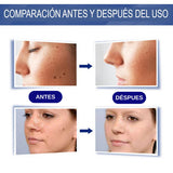 CREMA REMOVEDORA DE VERRUGAS - SUMIFUN 100% ORIGINAL